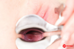 351 - Speculum in Action